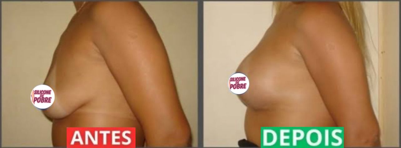 Antes e Depois Fernanda