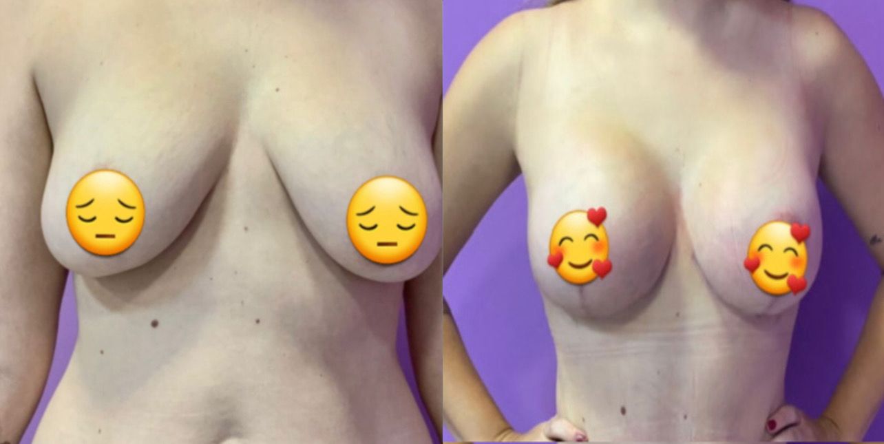 Antes e Depois 1